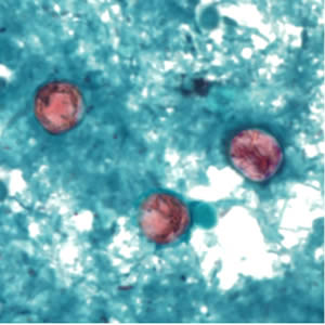 cyclospora cayatenensis Cyclospora infection last reviewed: august 2017 what is cyclospora infection cyclospora is a microscopic (tiny, not seen without a microscope) parasite that can. cyclospora cayatenensis Cyclospora infection last reviewed: august 2017 what is cyclospora infection cyclospora is a microscopic (tiny, not seen without a microscope) parasite that can.