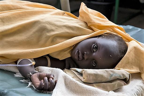 Child with cholera
