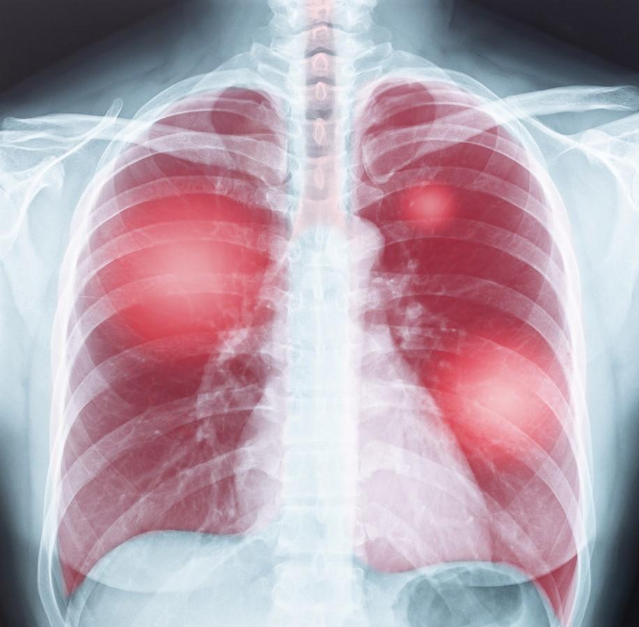 Chest x-ray with lungs shown in red