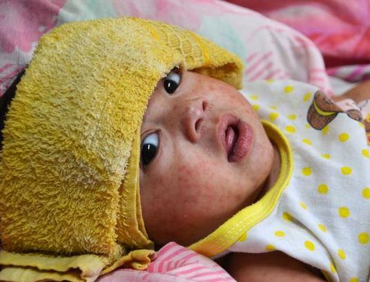 Measles-infected child