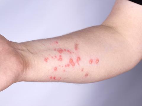 Blisters and rash on forearm