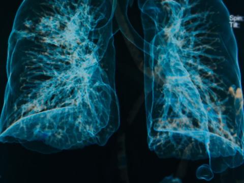 Lung imaging