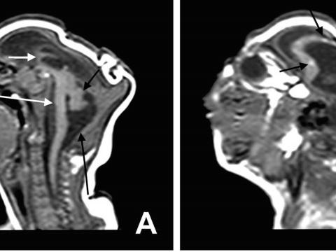 Microcephaly MRI