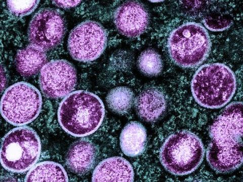 Monkeypox viruses under microscope