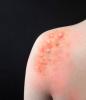 Monkeypox blisters on shoulder