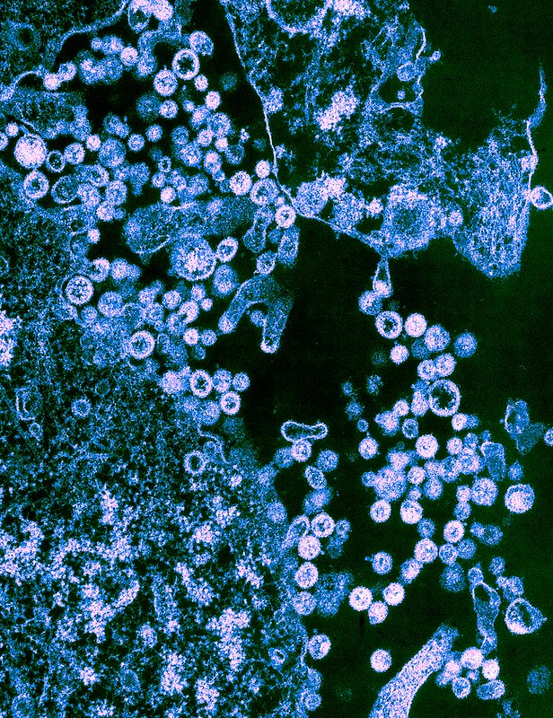 lassa fever