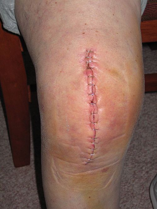 knee replacement stitches