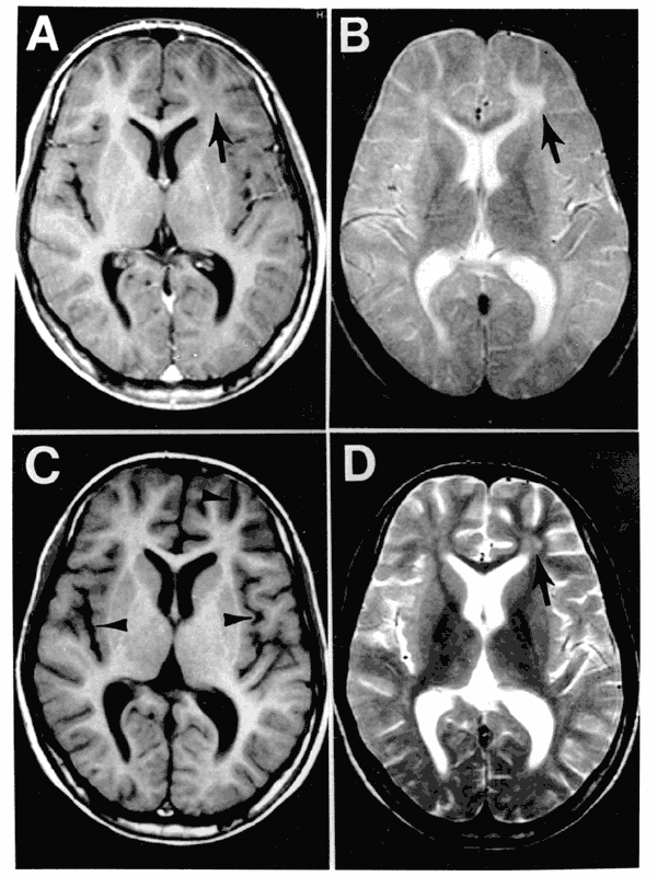 Black and white MRI scans showing the top of a brain with SSPE.