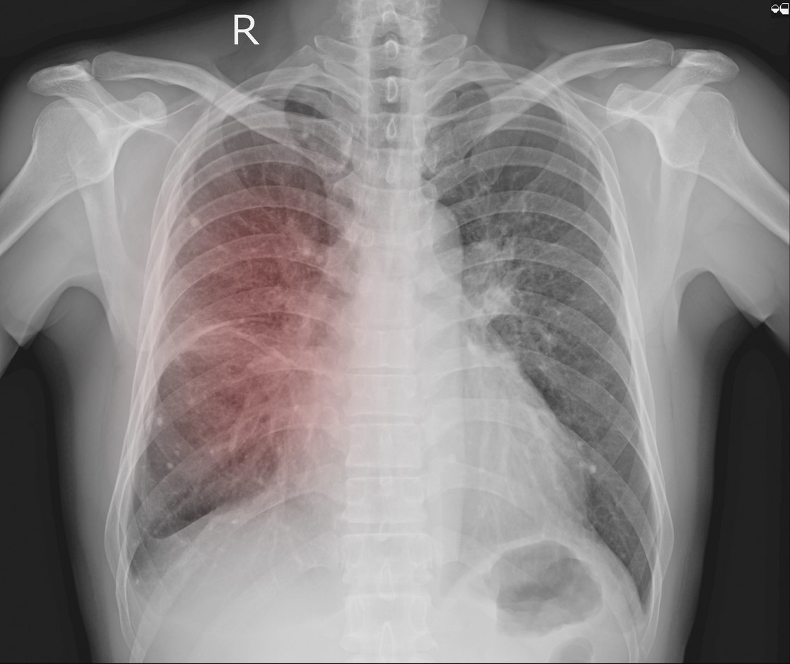 chest x-ray