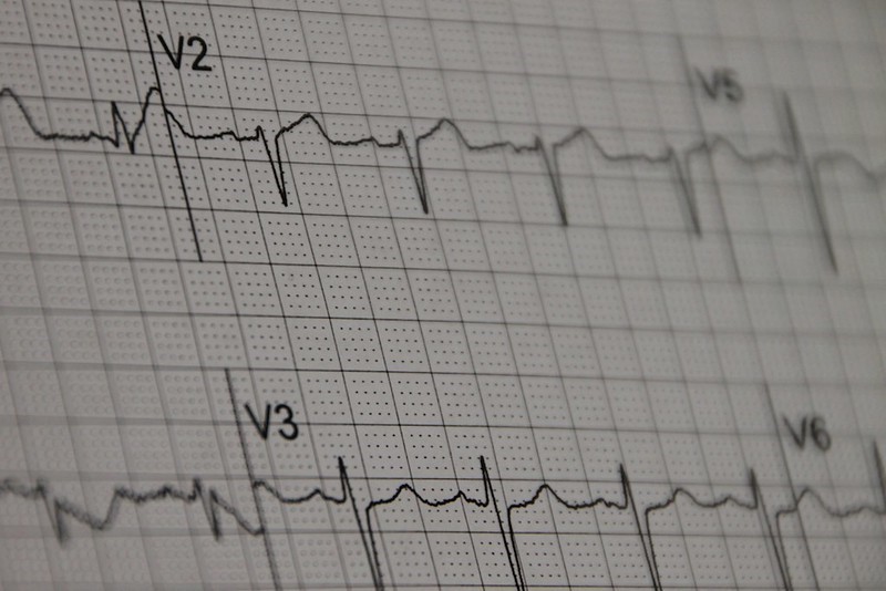 EKG readout