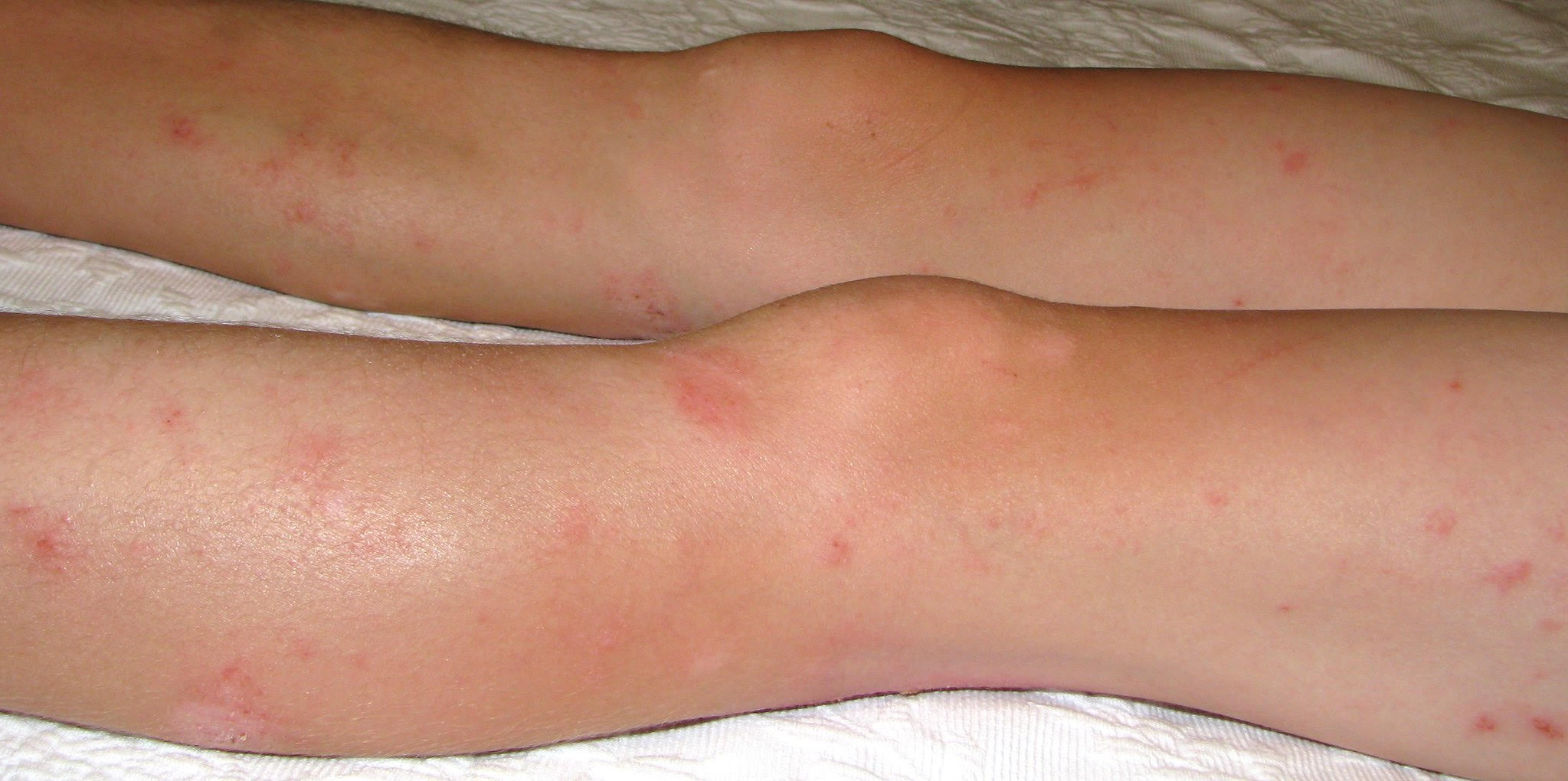 Eczema on legs