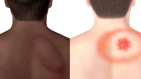 Lyme disease rash on Black and White skin