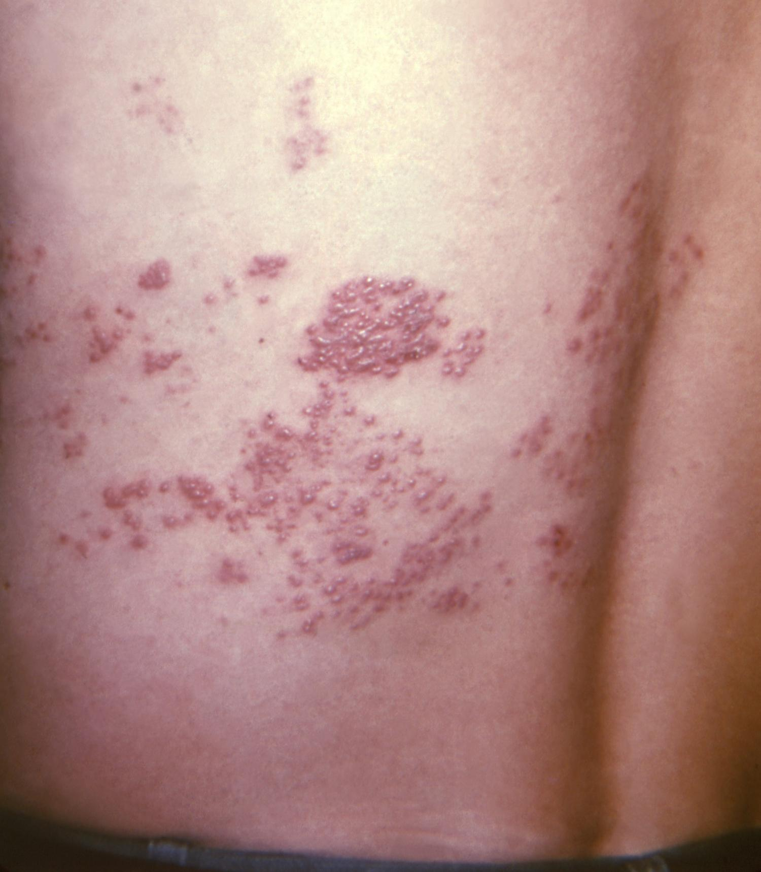 Shingles rash