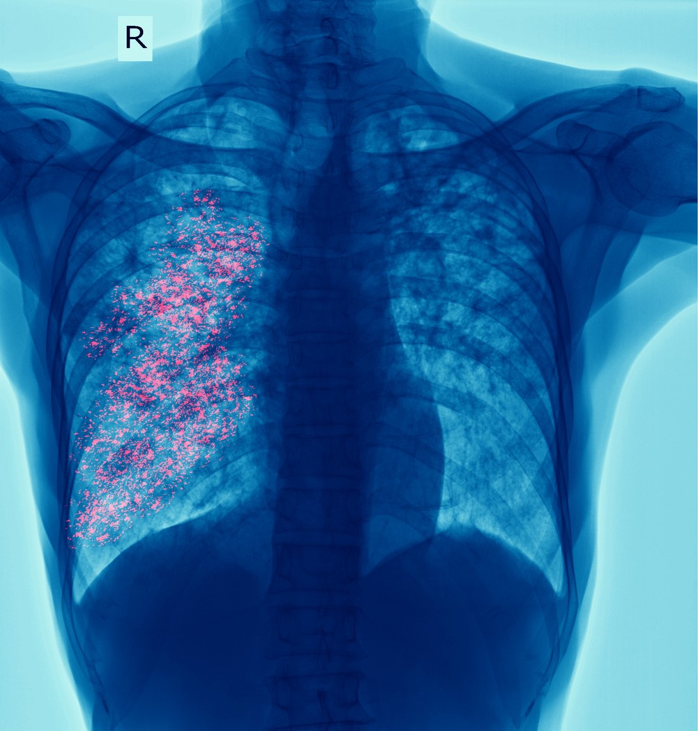 TB in red on x-ray