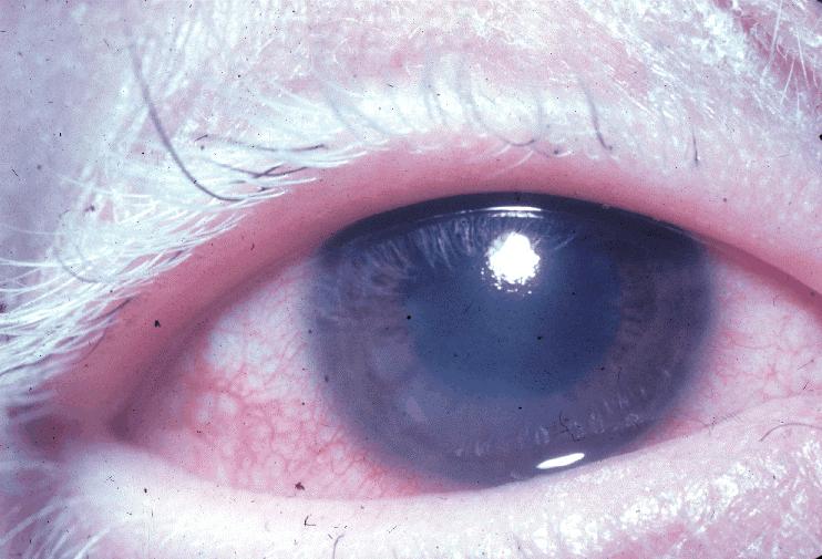 Uveitis