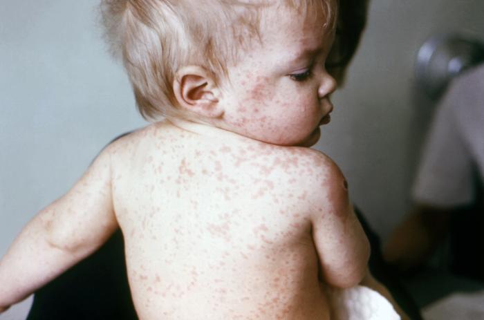 measles