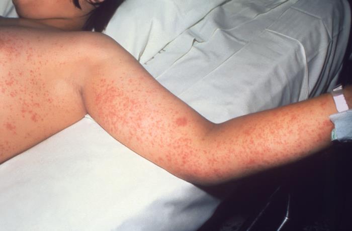 atypical measles
