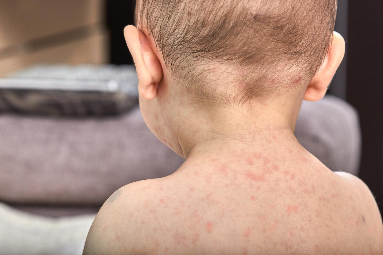 baby measles back