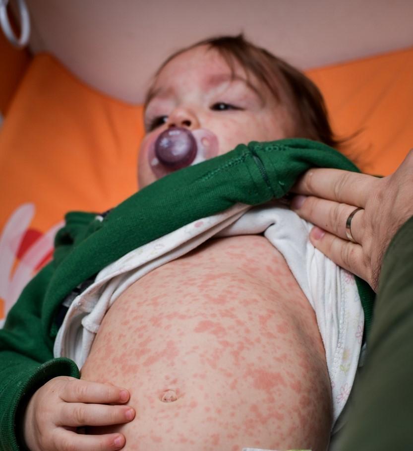 baby with measles