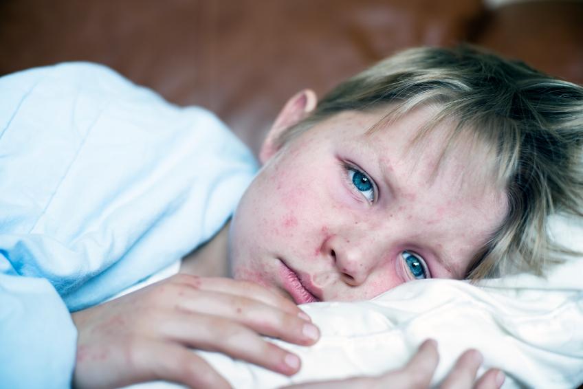 Young boy with measles lying in bed