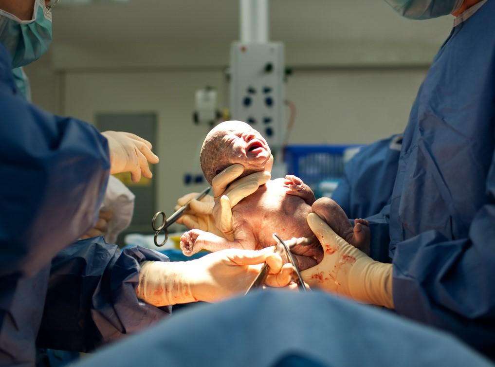 Baby delivered by C-section