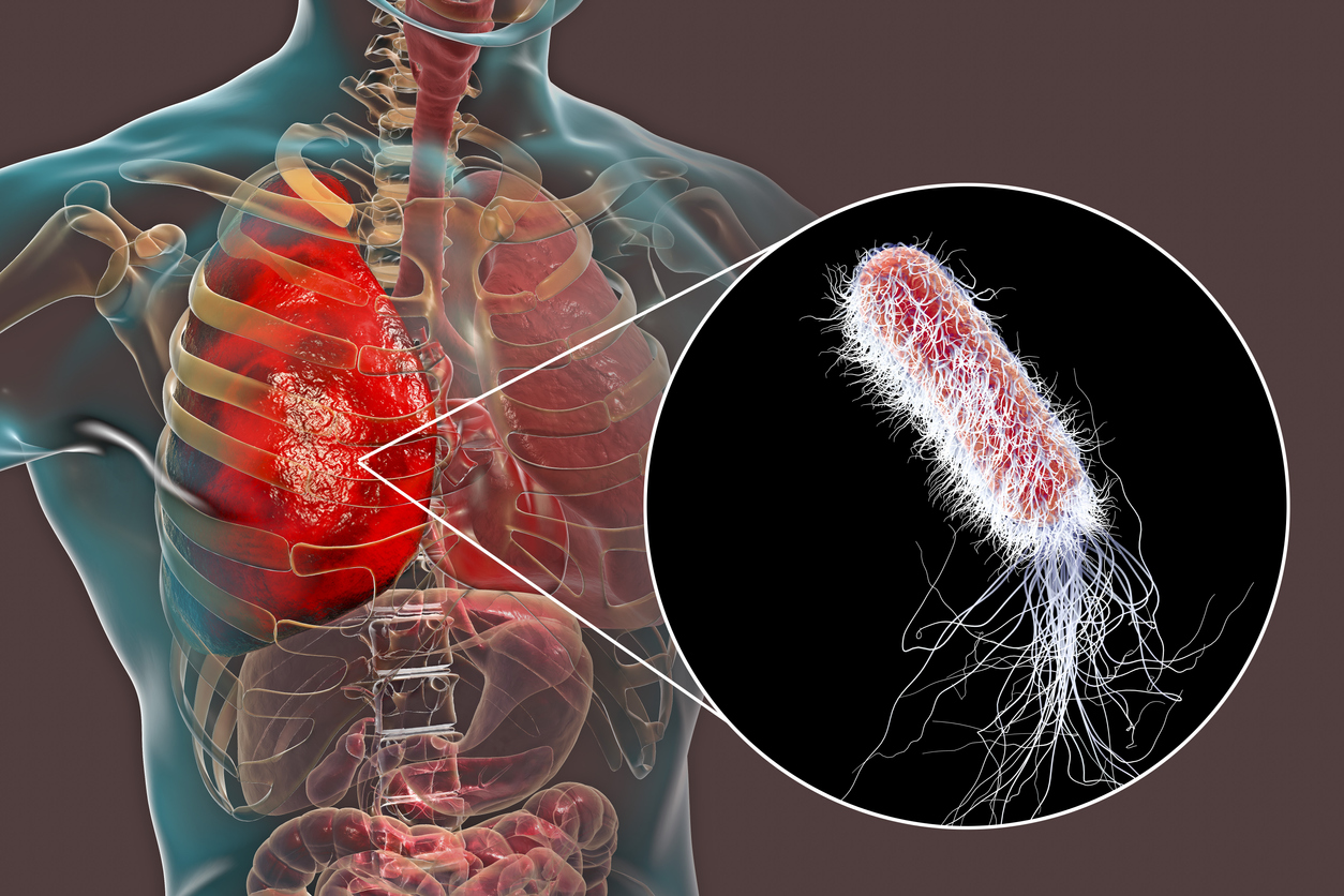 Lung infection caused by Pseudomonas