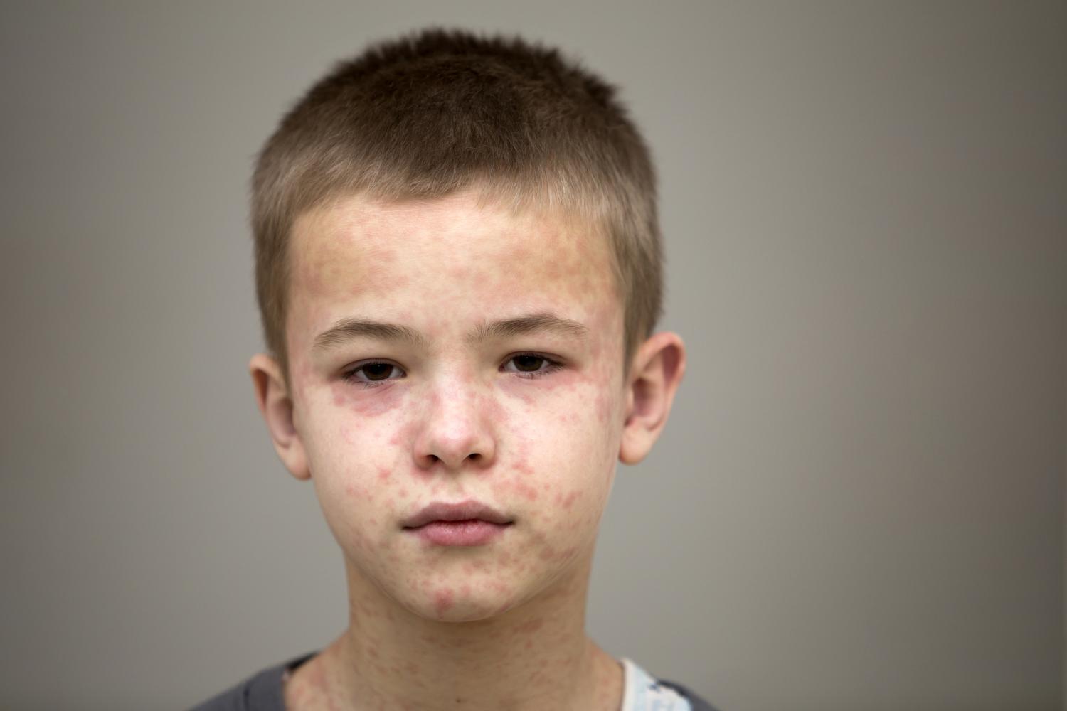 measles boy