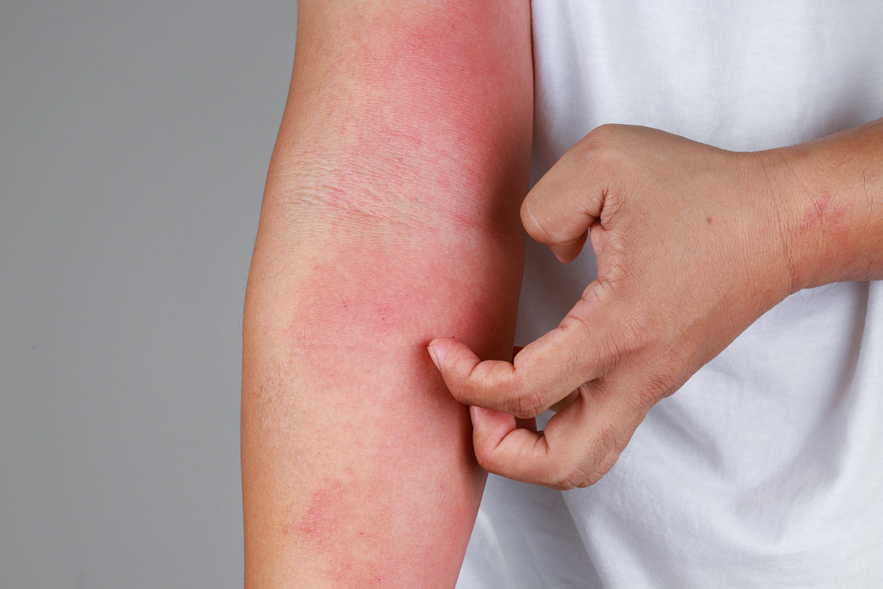 atopic dermatitis
