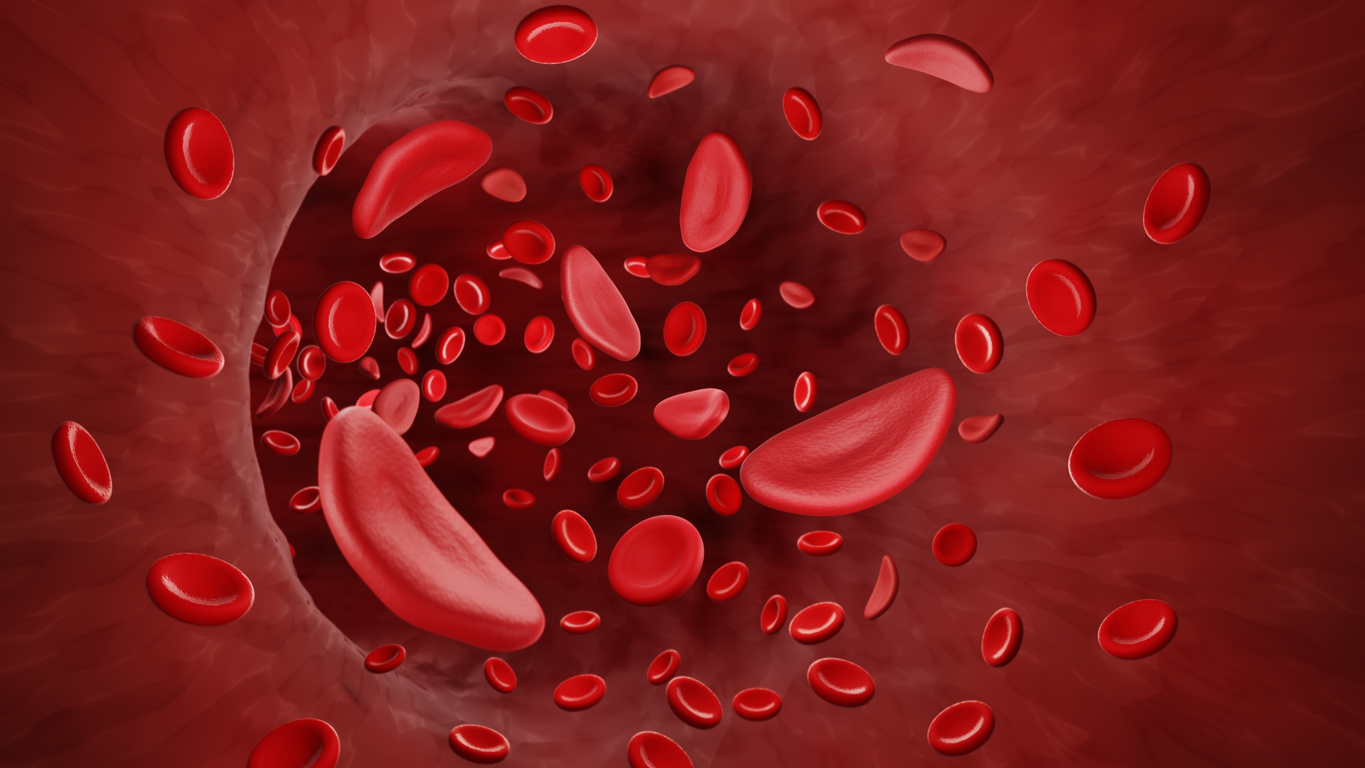 Sickle cells in blood