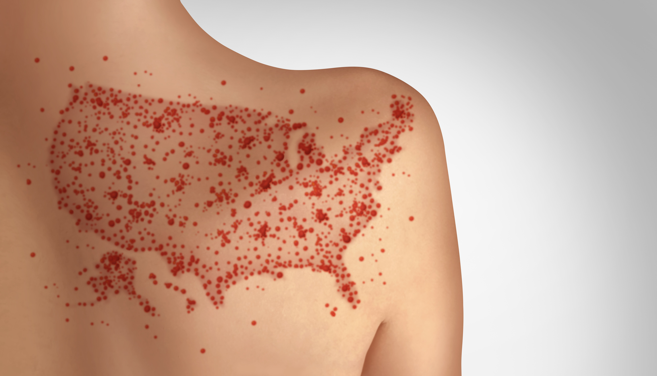 Illustration of US measles outbreak on back of young child