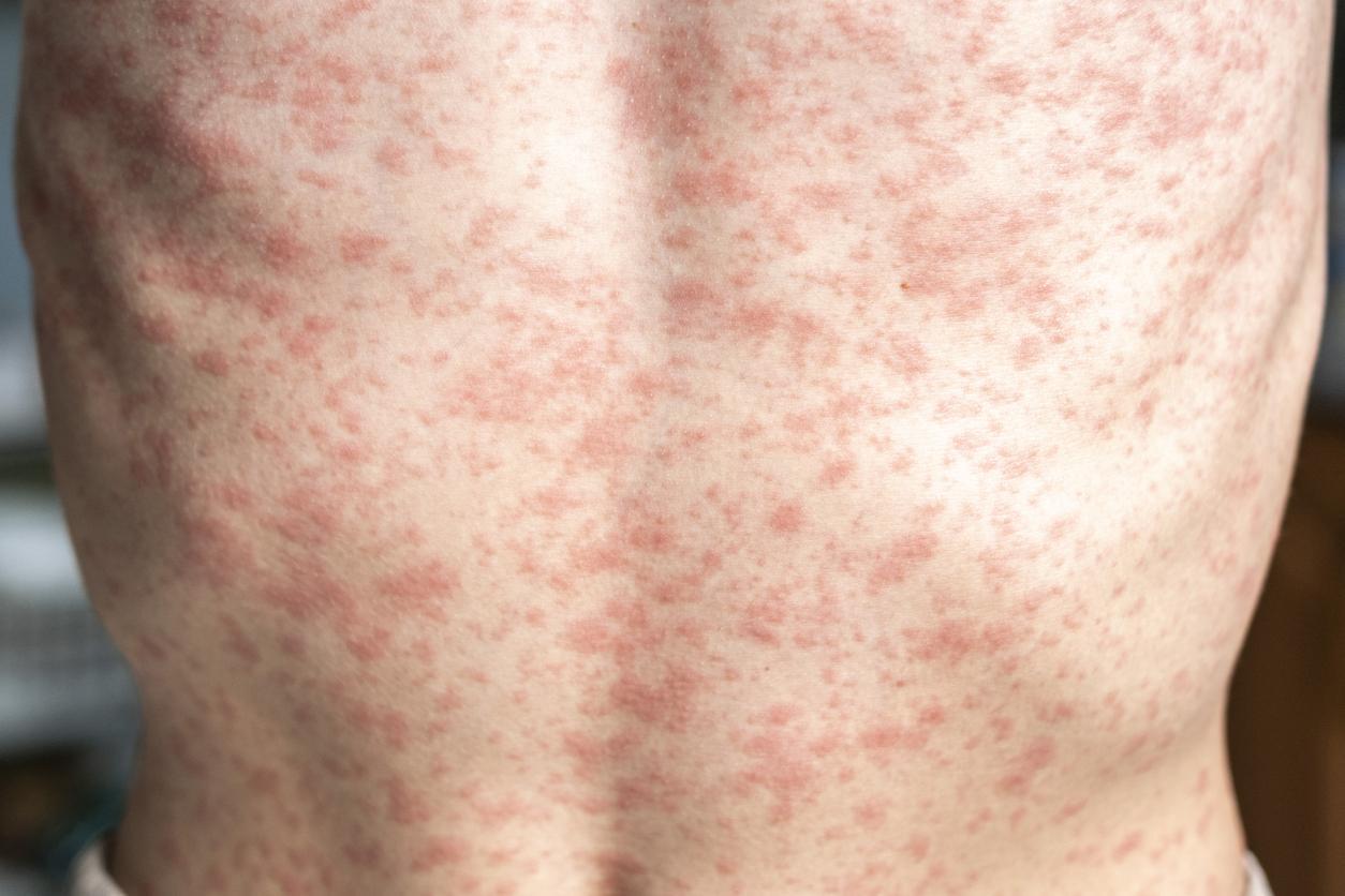 measles on back 