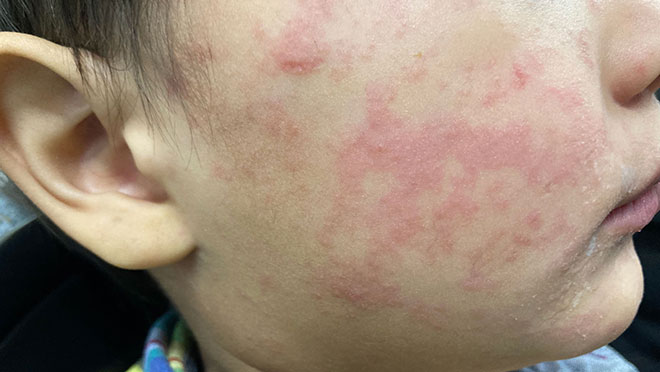 measles rash on cheek