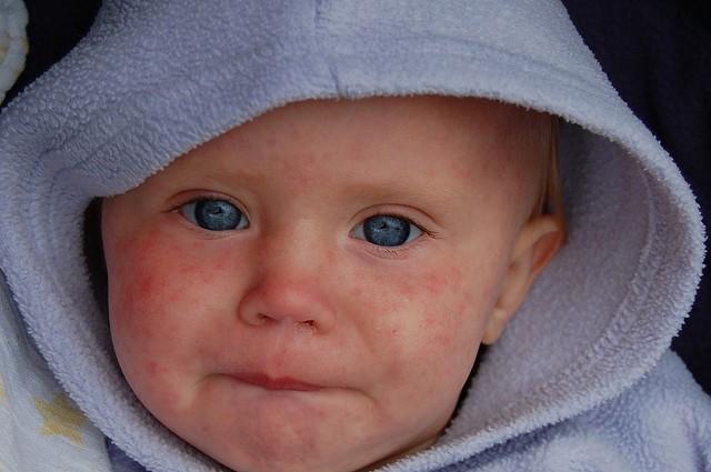 measles baby