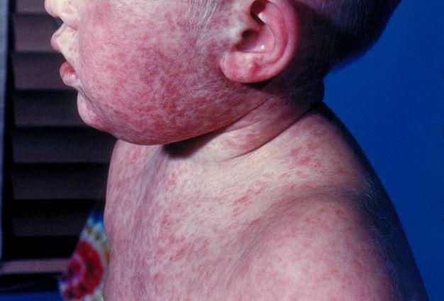 Toddler with measles
