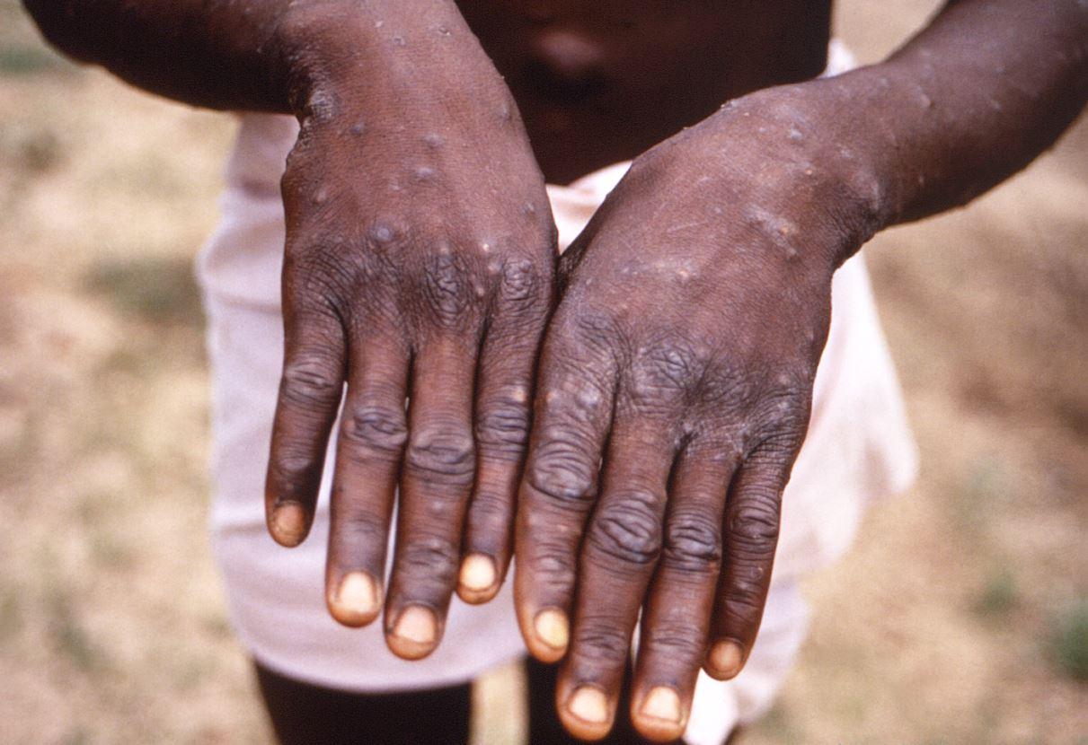mpox lesions on the back of hands