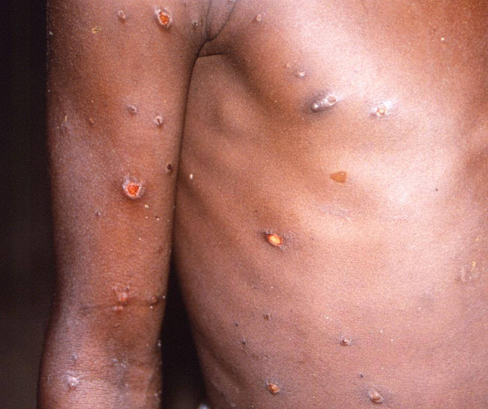 mpox patients