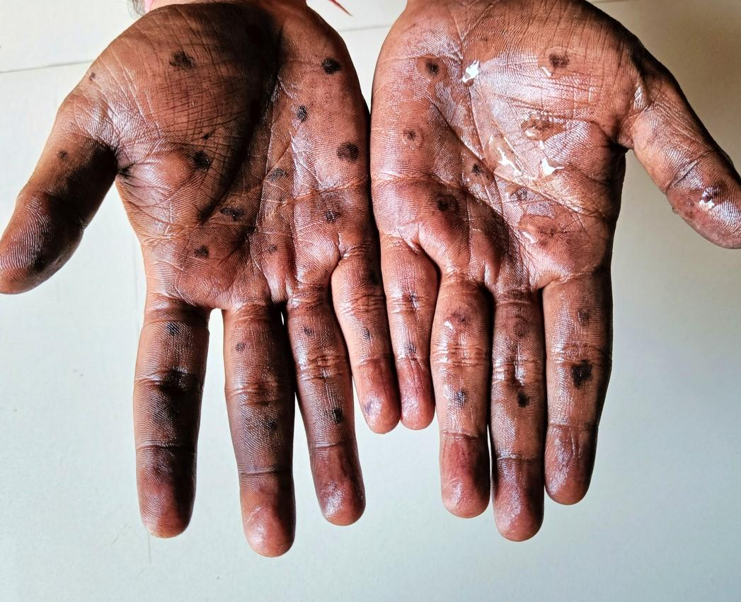 mpox rash on hands