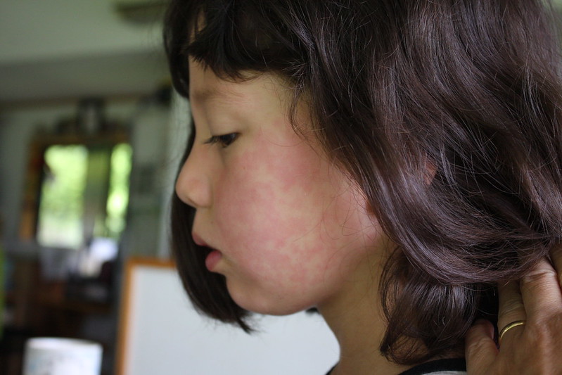 child with face rash