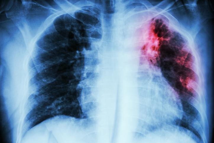 pulmonary TB