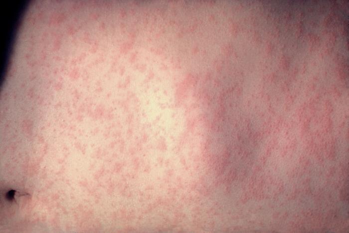 measles rash