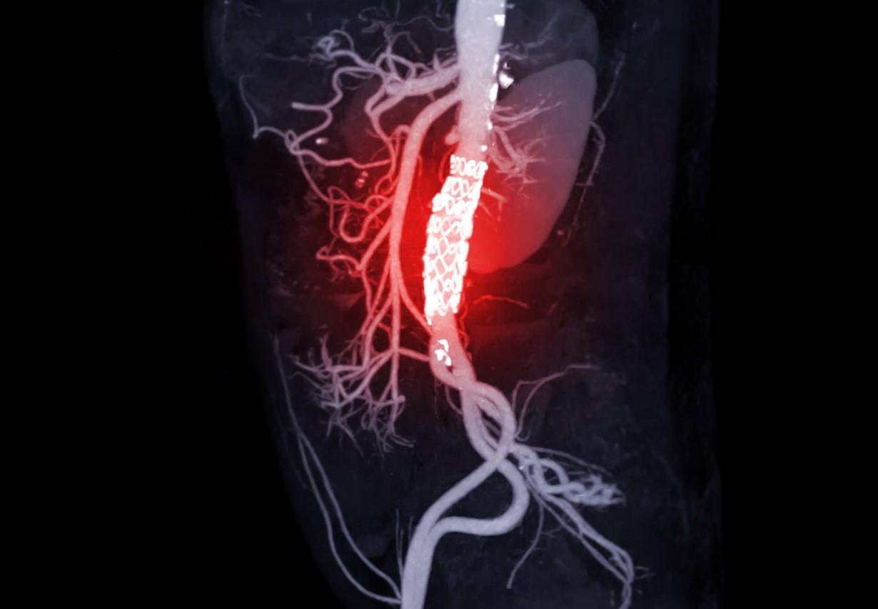 Aortic dissection