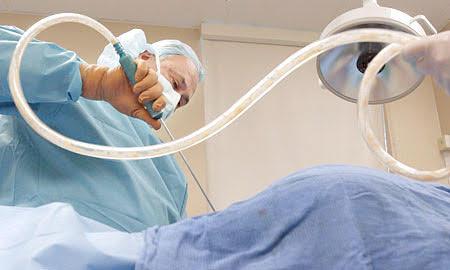 Liposuction