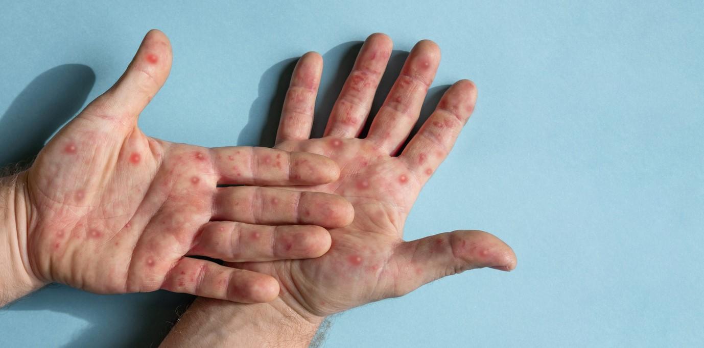 mpox hands