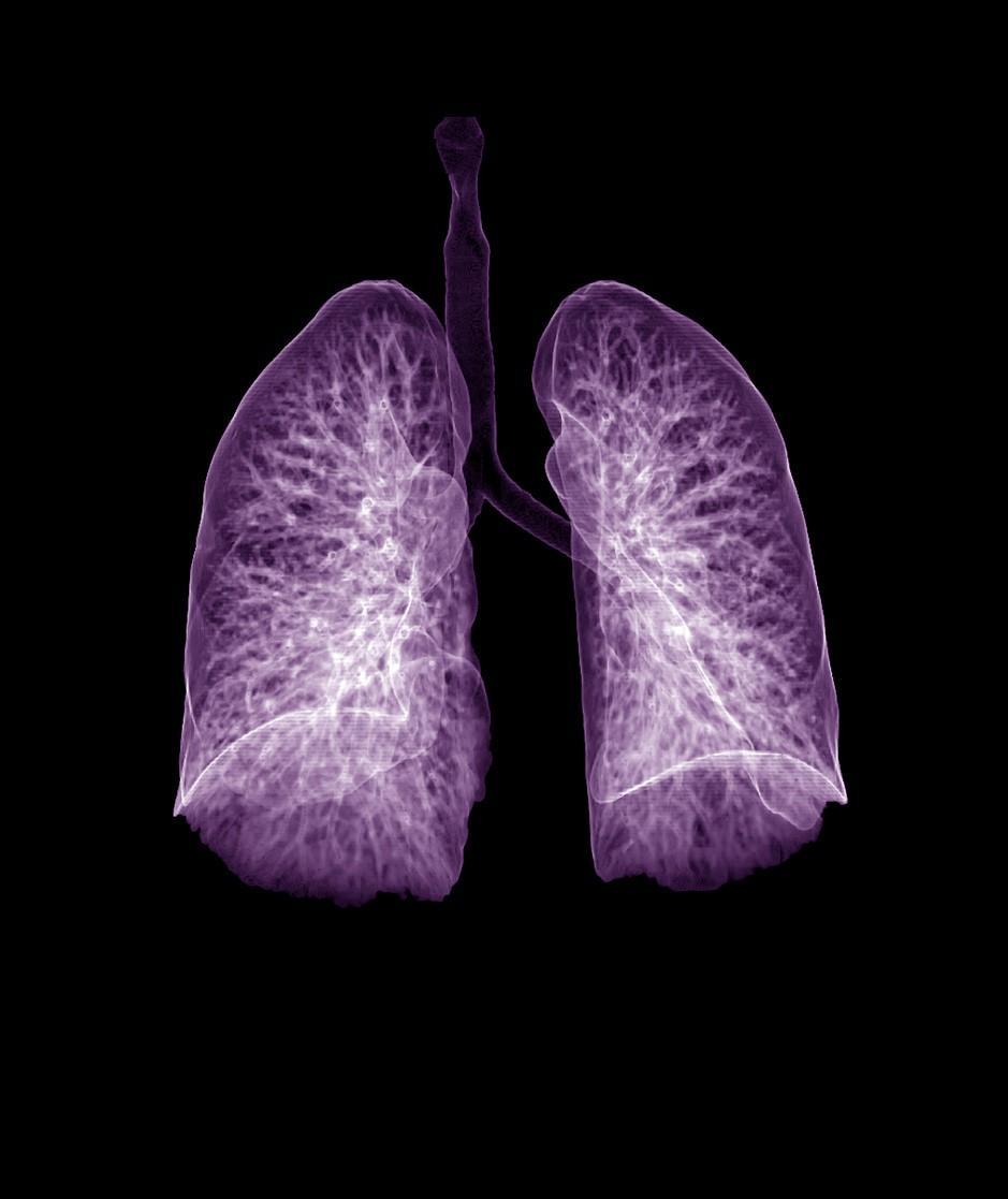 Purple lungs on x-ray