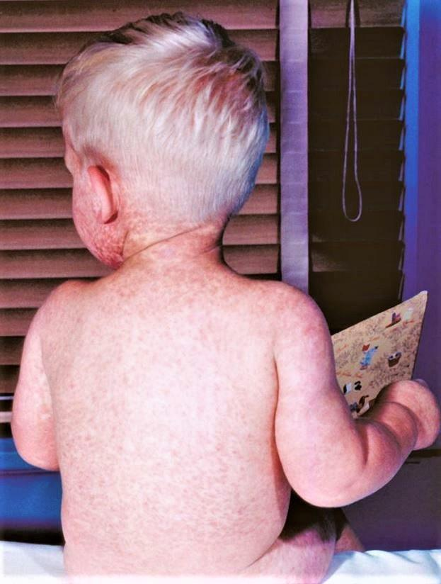 Toddler boy with measles