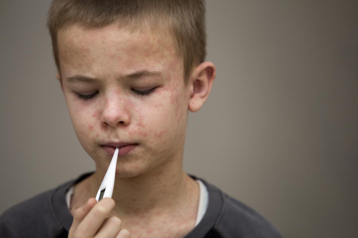 boy with measles