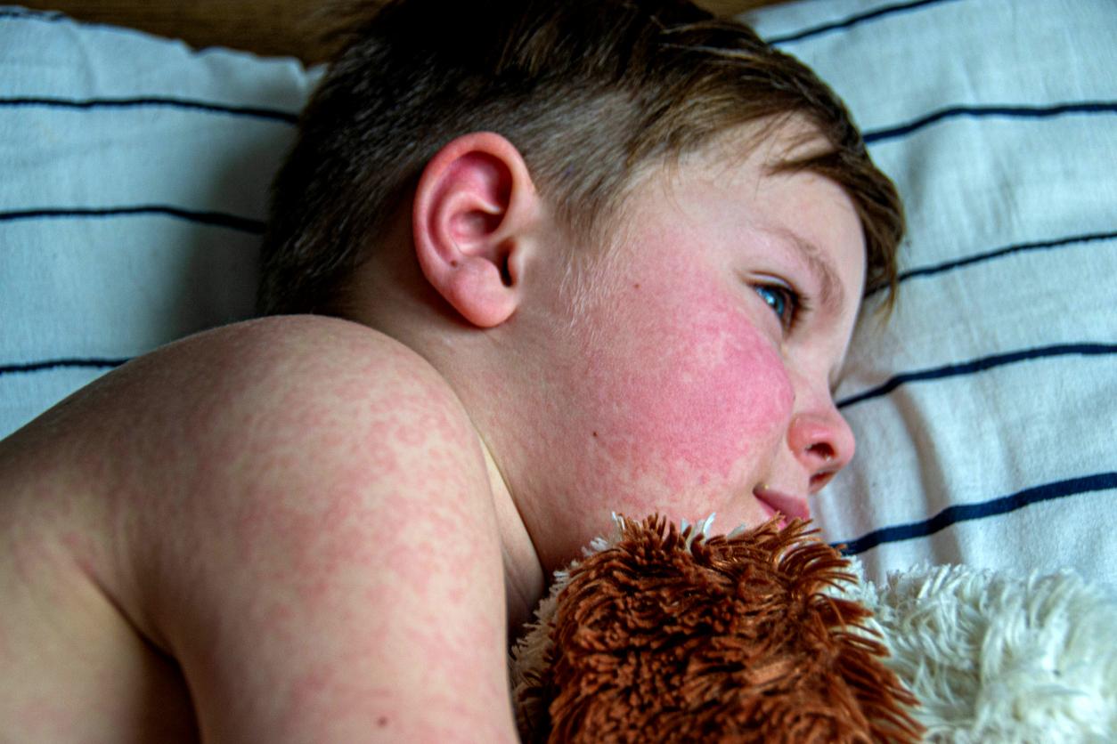 boy with measles