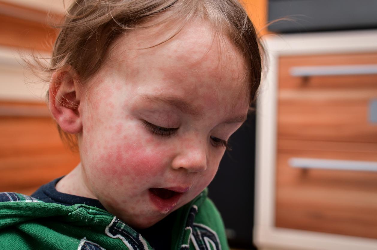 child with measles