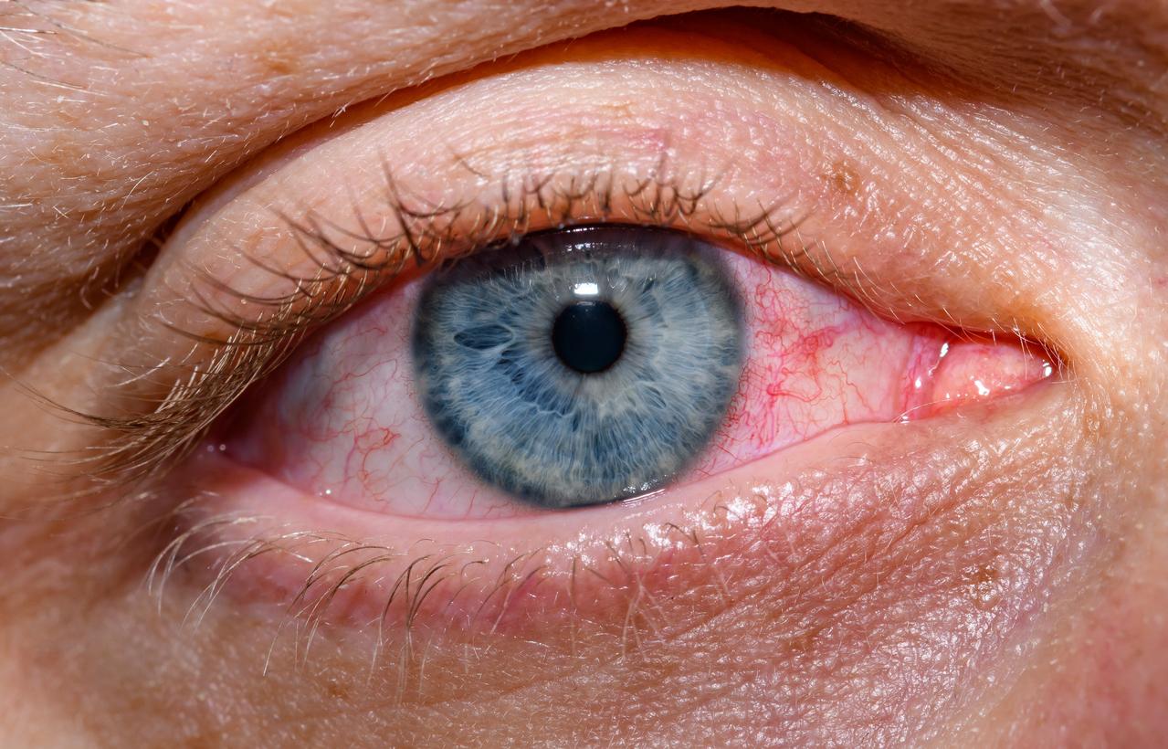 conjunctivitis