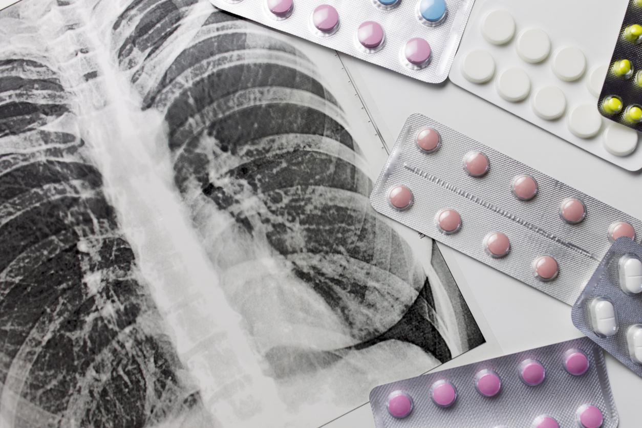 TB x-ray and pills